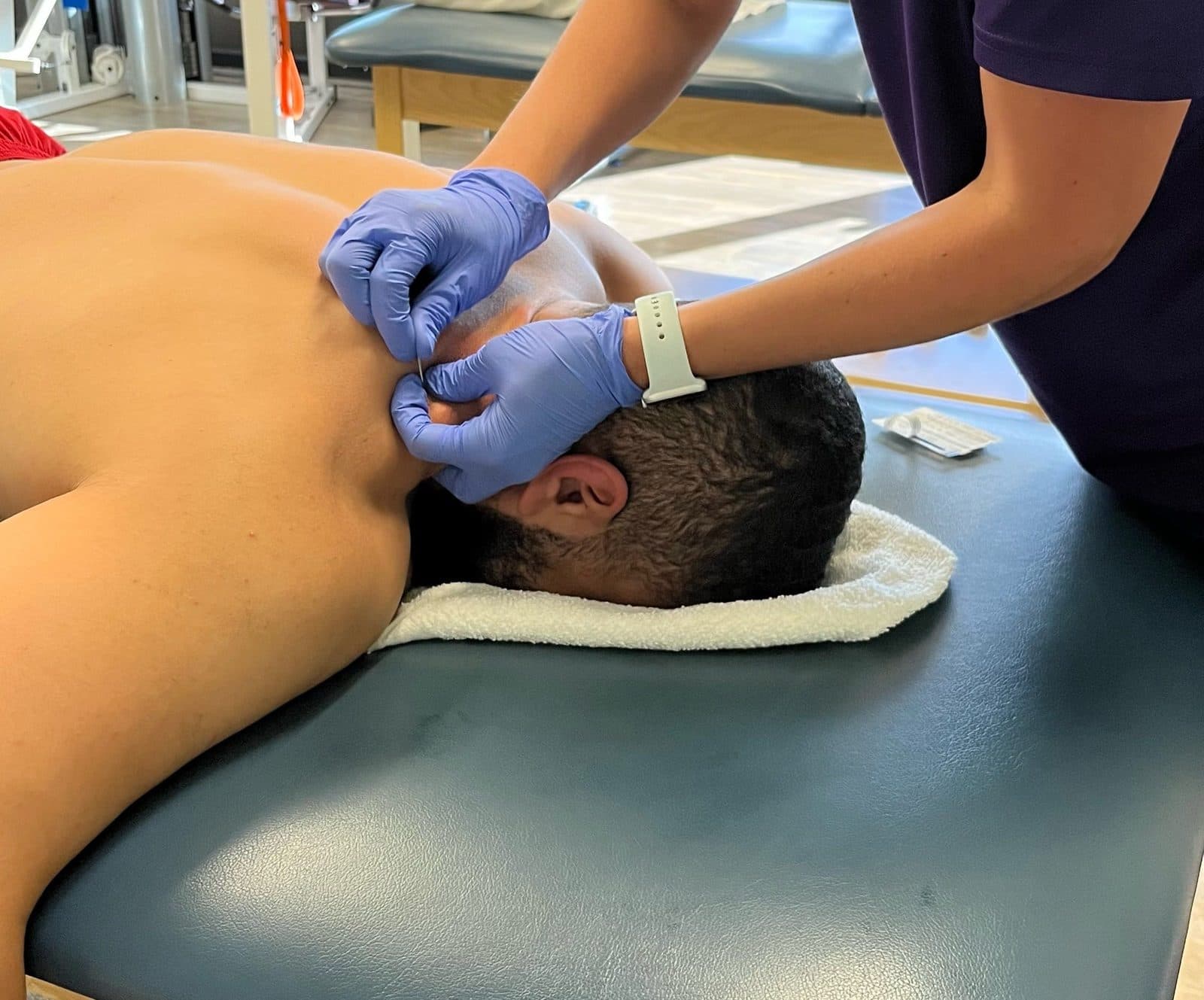 Gloved hands placing a dry needle in the upper trapezius while a patient lies face down on the treatment table.